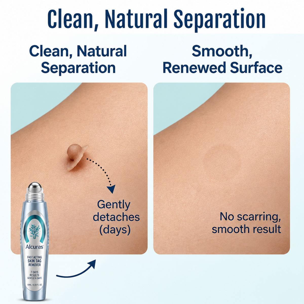 Alcuras® SpotlessPro Advanced Skin Care Pen